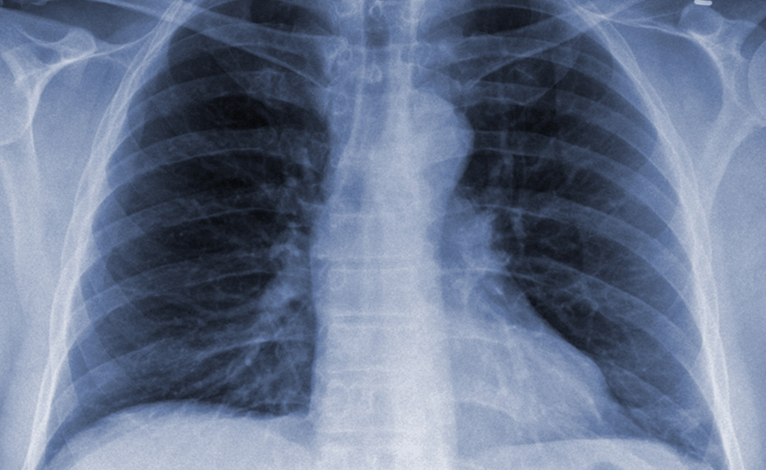 Community-Acquired Pneumonia Can Spread Year-Round | Physician's Weekly ...