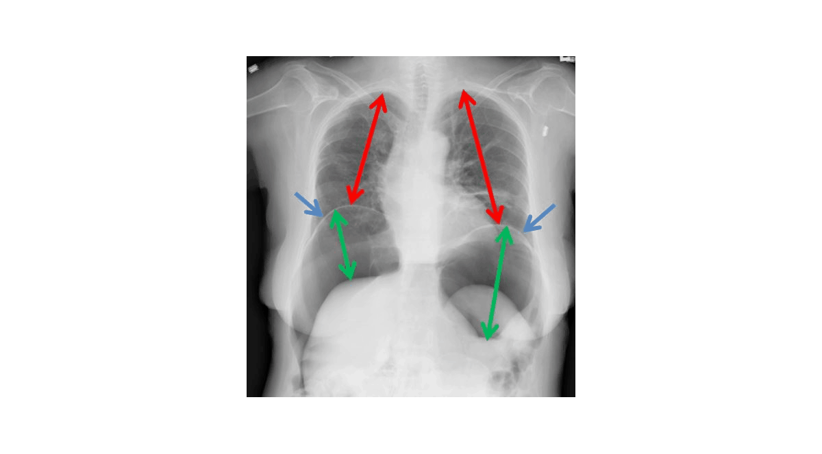 Permanent Catheter In Bladder