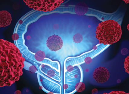 Prostate Cancer Tumorigenesis: Exploring Molecular Biomarkers and Their ...