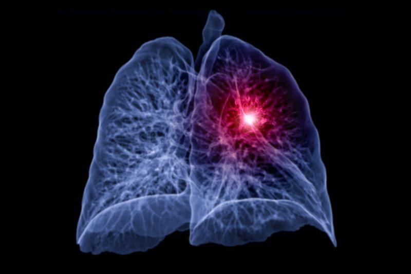 Chemoradiation With SABR Boost Safe, Effective for Advanced Lung Cancer ...