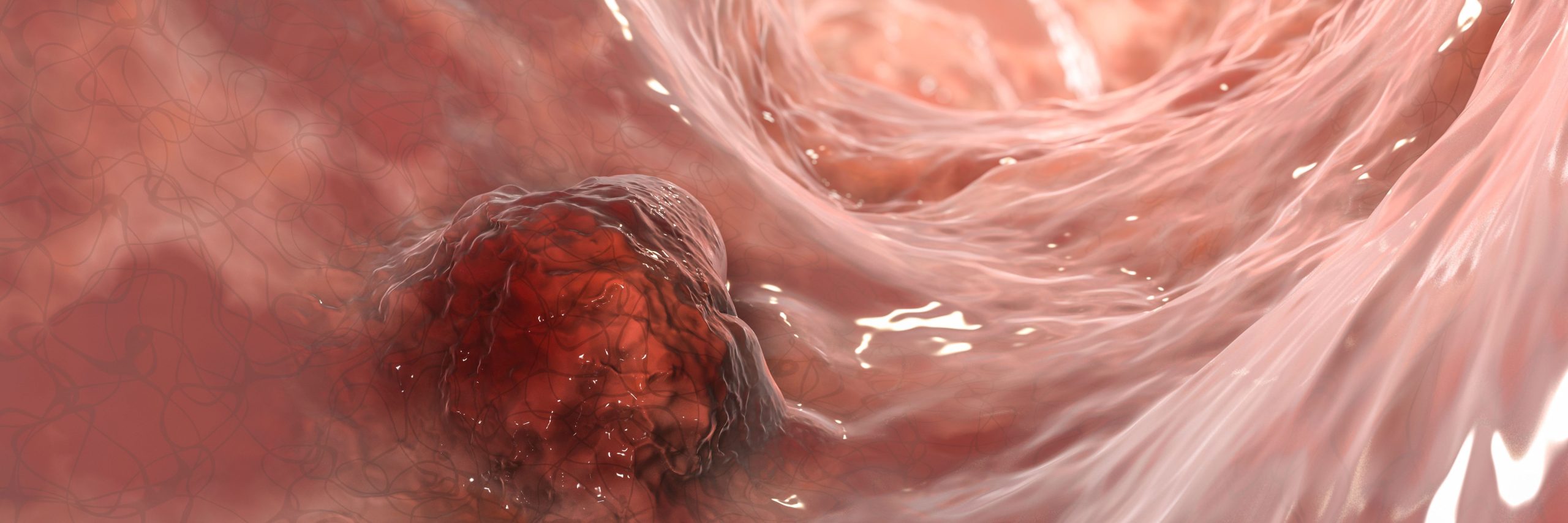 analyzing-the-use-of-prostate-biopsy-method-in-patients-without-rectum