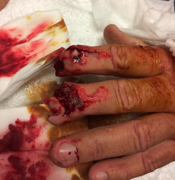 Pallet of Cinder Blocks Falls onto Patient Hand