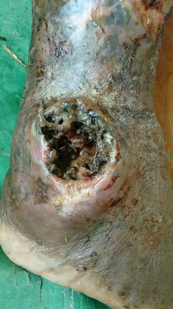 Wound With Maggot Formation